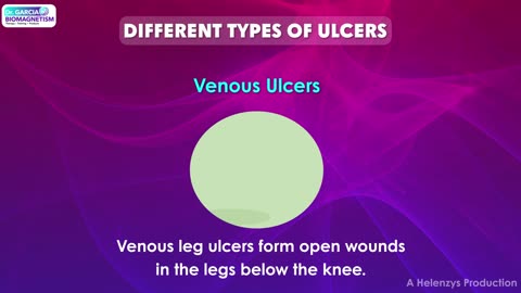 What is an Ulcer?