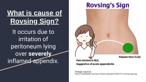 Rovsing's Sign for Diagnosing Acute Appendicitis | Novice Medic