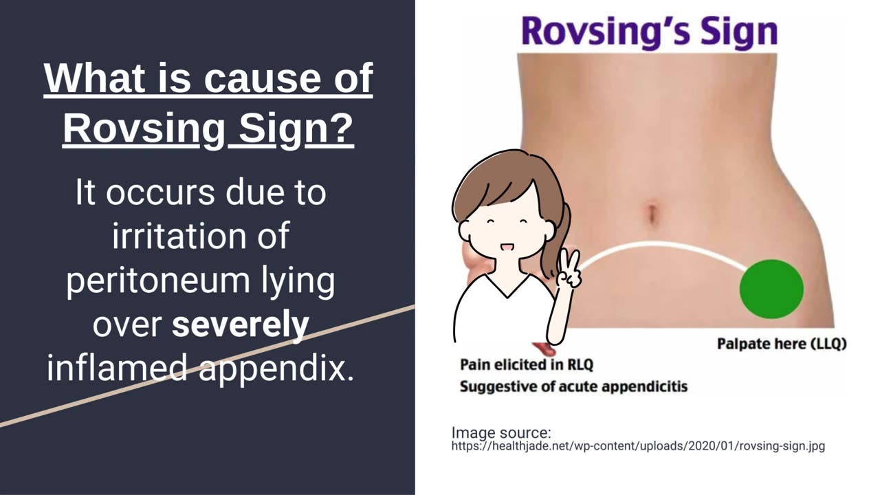 Rovsing's Sign for Diagnosing Acute Appendicitis | Novice Medic