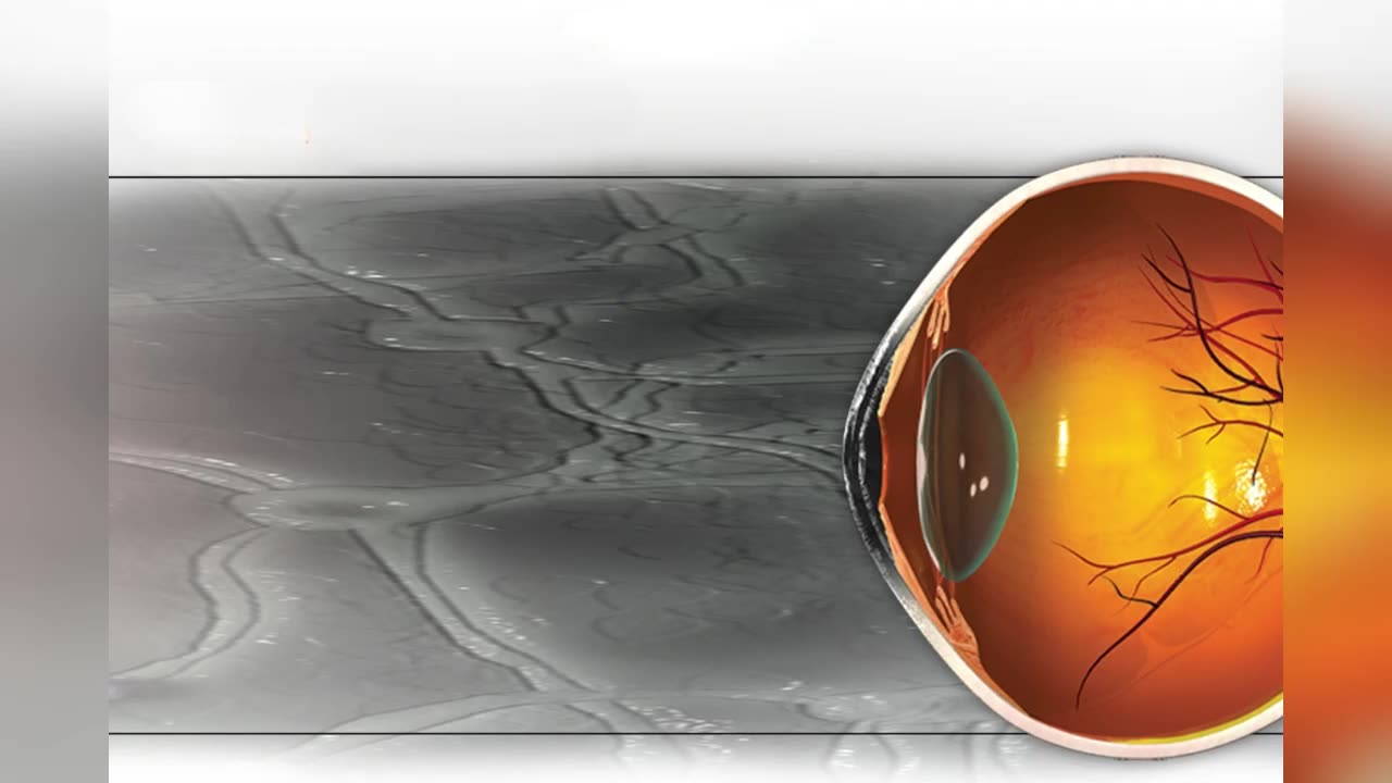 LASIK and Cataract