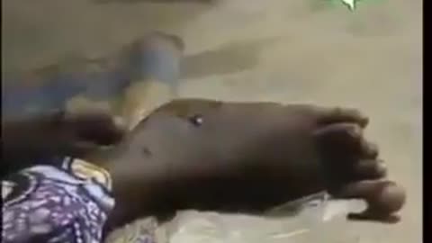 Quando la Pfizer sperimentò sui bambini africani