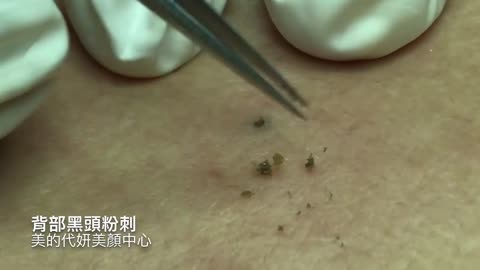 Best Blackhead Removal