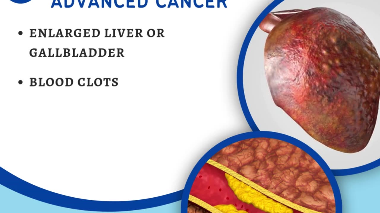 Symptoms of Pancreatic Cancer