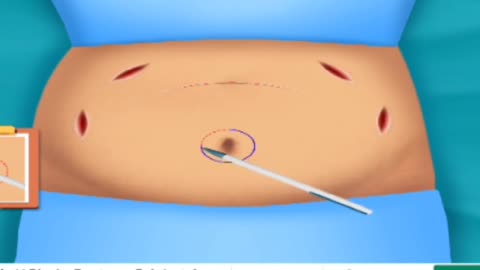 Tummy tuck procedure animation