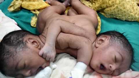 Rare in the world two head baby born in nepal