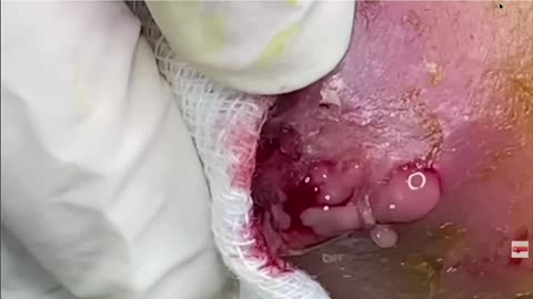 CYST DRAINAGE SEVERE CYSTIC ACNE WHITEHEADS BLACKHEADS