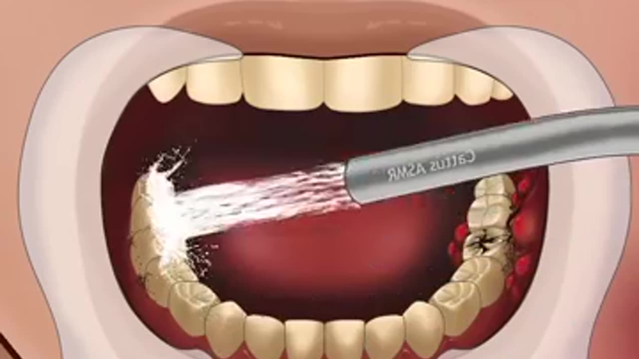 ASMR Treatment of Severe Tooth Decay Part 1 #satisfying #mushroomasmr68 #trendingshorts