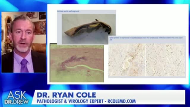 Dr Cole Vaxx leads to Spike deposition all over Body & CNS, also causing aneurysms