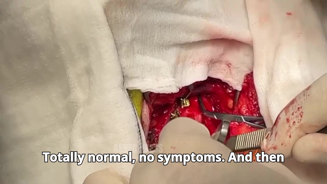YOUTUBE REMOVED mRNA Injury- 2 Covid shots followed by infection 2X + booster – Dr John Campbell
