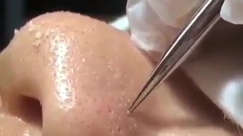 blackheads remove