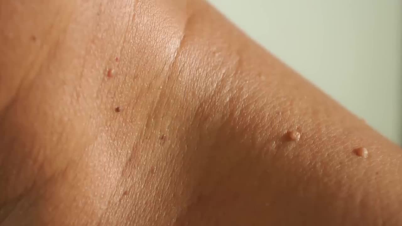 HOW TO REMOVE SKIN TAGS & WARTS~DR.BERG