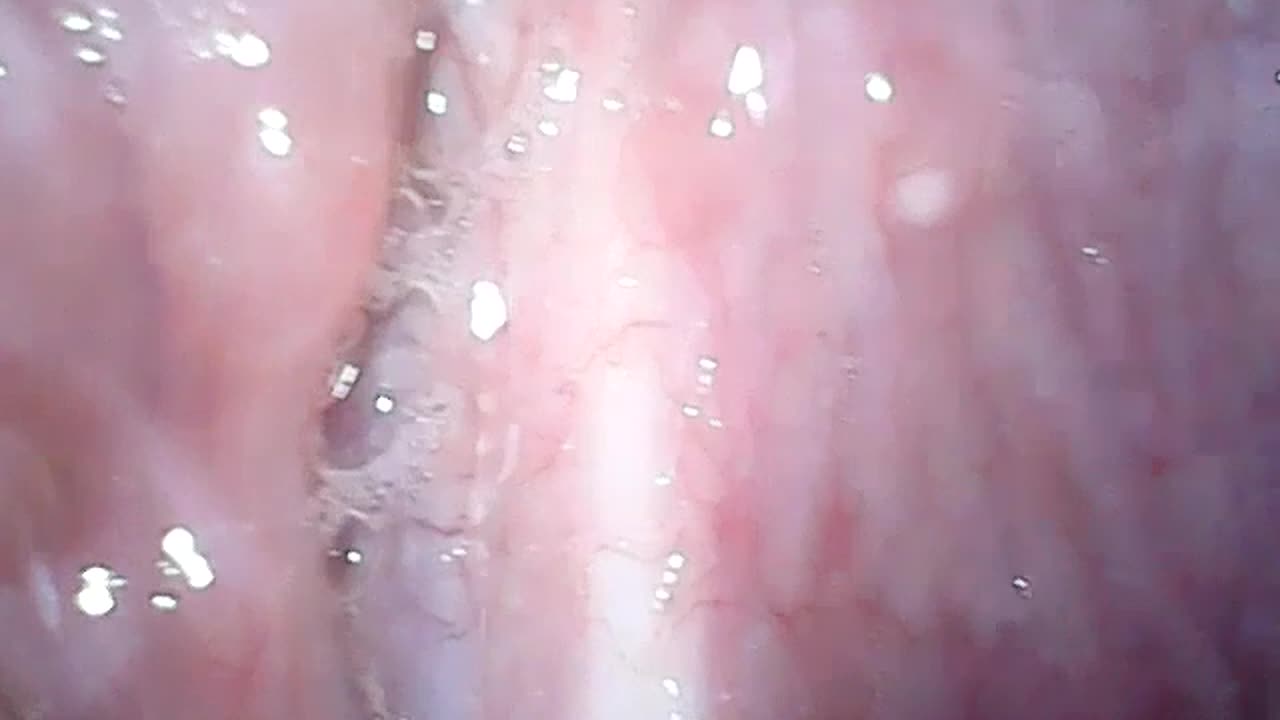 ROGUE INGROWING SCALP HAIRS SCARRING OF MUCOSAL MEMBRANE IN THROAT CONSTRICTING BLOOD FLOW TO BRAIN