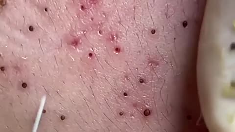 This What Your Remove Blackheads Should Popping