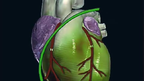 Bypass Surgery Explained | A Simple Guide to Heart Health 🩺😮 #health #heart #BypassSurgery