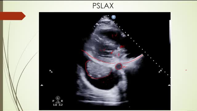 EFAST ultrasound