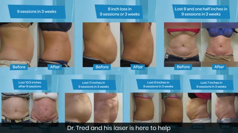 Can You LASER Your fat Away?