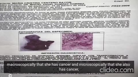 Colon cancer cured in double vaccinated woman. Dr. Chavez explains how she was cured in 5 months