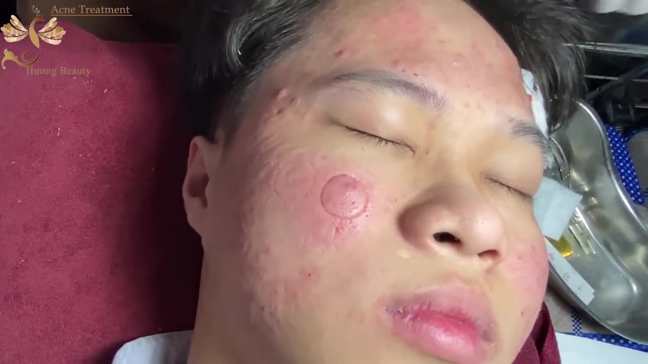 #152 | Acne Treatment Huong beauty | Part 2