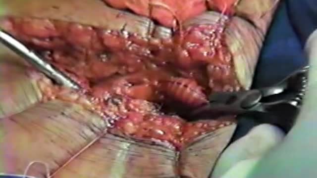1986 Derivação Aorto-femural com prótese