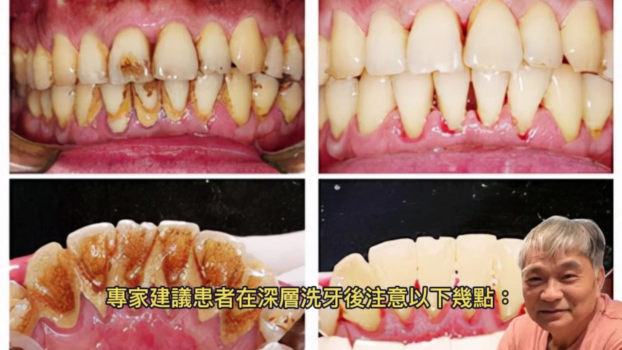 深層洗牙 牙周病患者福音