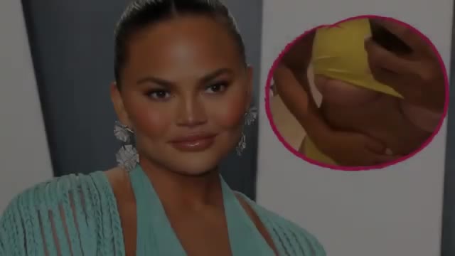 Chrissy Teigen has cheek fat removed as she celebrates sobriety.