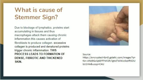 Stemmers Sign in Lymphedema: A Key Diagnostic Indicator Explained!