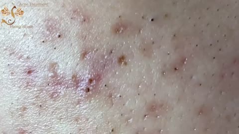 #140 | Acne Treatment Huong beauty