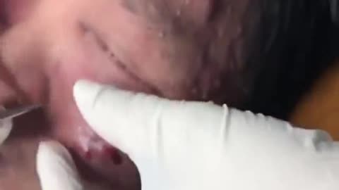 ##2 Satisfying Pimple Popping