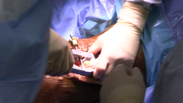 Total knee replacement