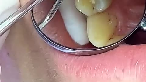 Tooth Decay Removal