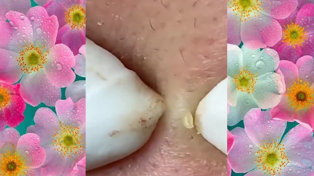 big-cystic-acne-blackheads-extraction-blackheads-milia-whiteheads-removal pimple-popping