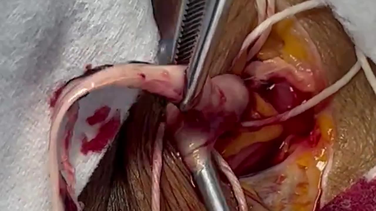 Blood clot extraction-Dr Richard Hirschman-Enbalmer