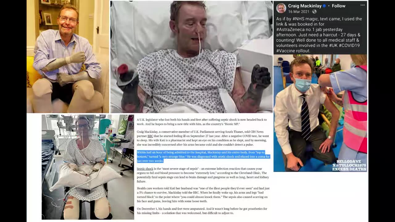 UK Member of Parliament Craig Mackinlay Developed Mysterious Vaccine-Induced Disease (Sepsis)