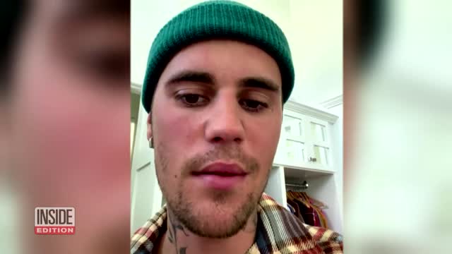 Justin Bieber Says Half His Face Is Paralyzed