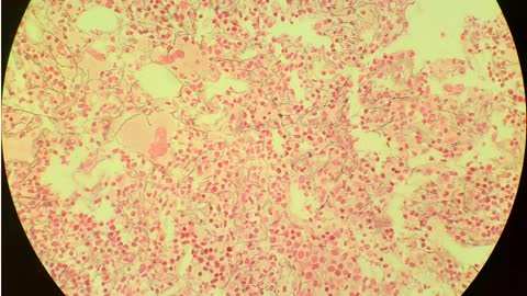 retic 1-2+ T-cell