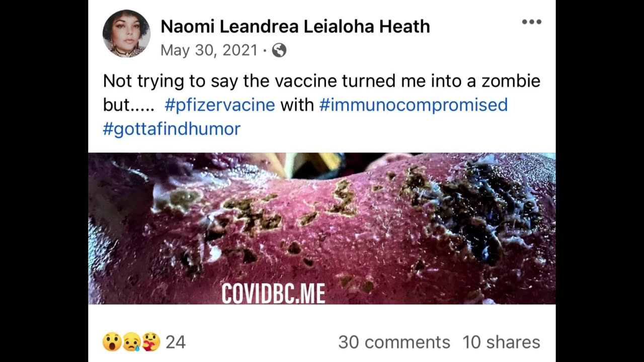 Horrific Photos on Social Media - Vaccine-induced Skin Disease - Here's Video Proof