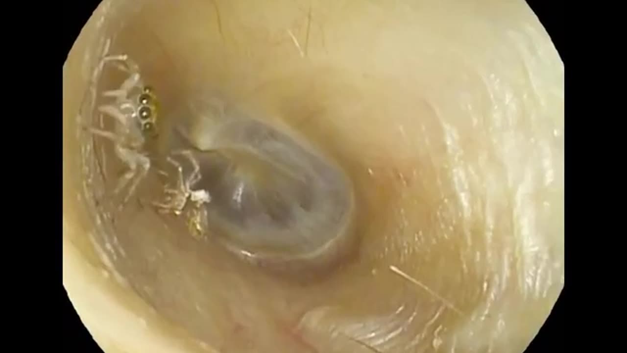 A SPIDER HAS TAKEN UP RESIDENCE IN A WOMAN’S EAR