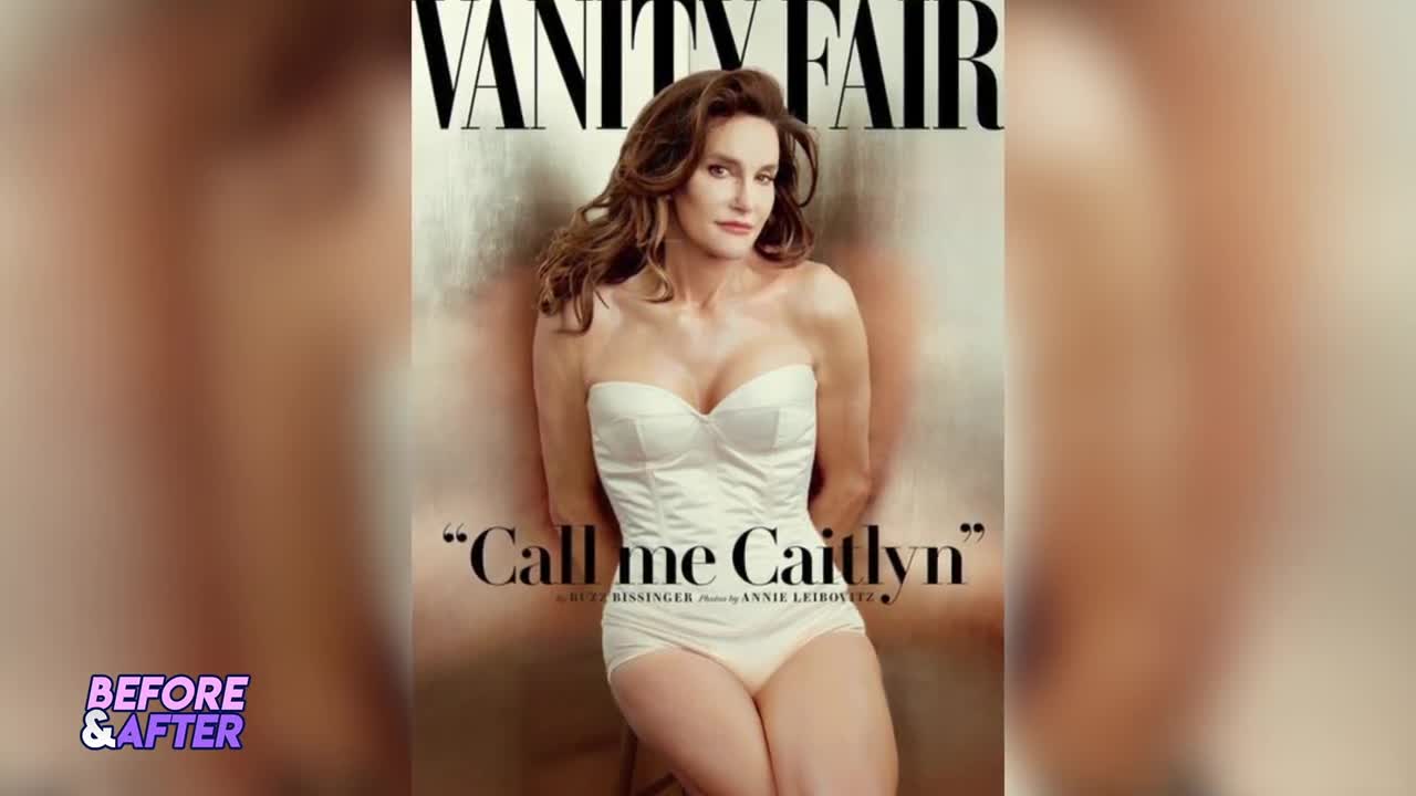 Caitlyn Jenner | Before and After Transformations | Plastic Surgery Bruce to Caitlyn