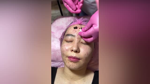 Big pimples removal