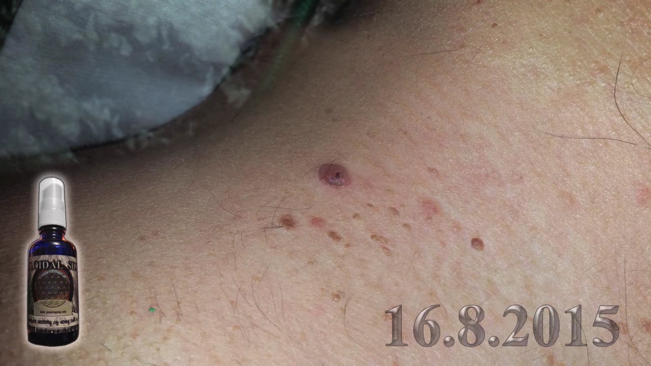 WART ON A NECK and COLLOIDAL SILVER