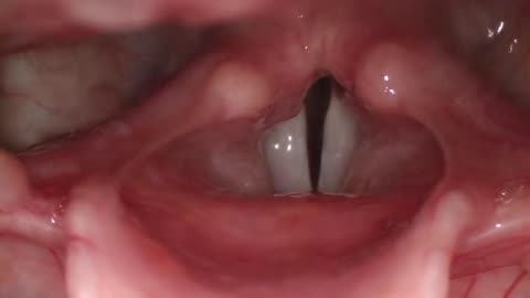 Normal Female Vocal Cords