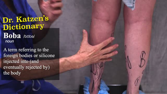 GRAPHIC: Removal of Silicone from Lower Legs, Calves, and Ankles + Patient Testimonial!