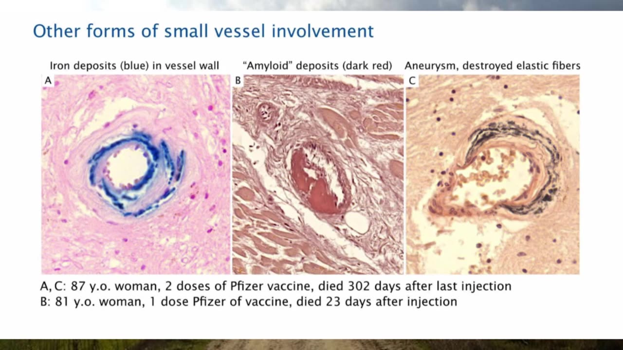 Pathologist Arne Burkhardt Final Interview - Revealing the Grave Dangers of mRNA Vaccines