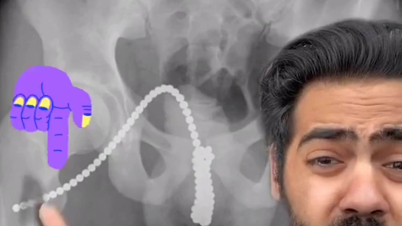 Weird things found in people's bodies