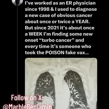 Since 2021 it's I'm finding some new onset "turbo cancer" and every time it's someone who took the💉