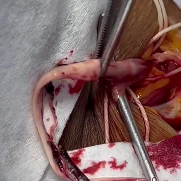 Fibrous clot. You know what from