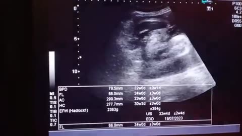 Gender Determination Female Gender At 31 Week of 18 Years Old Lady with Posterior Placenta