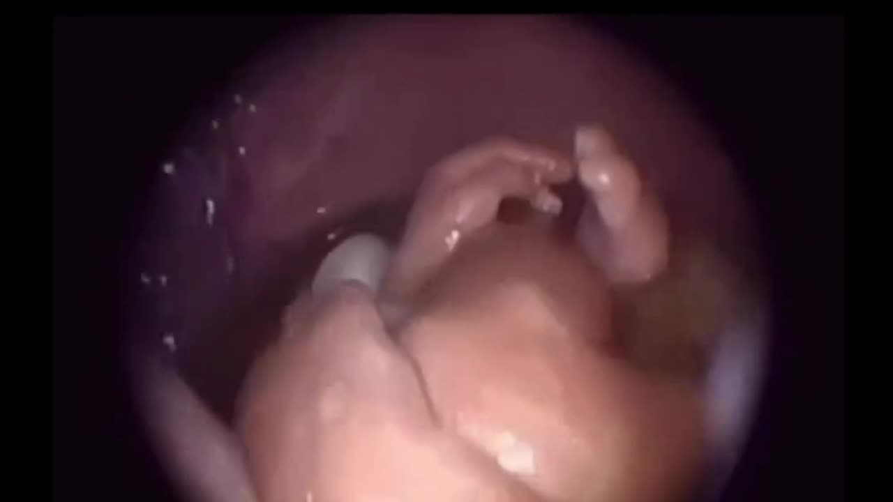 Real Footage of fetus in the uterus