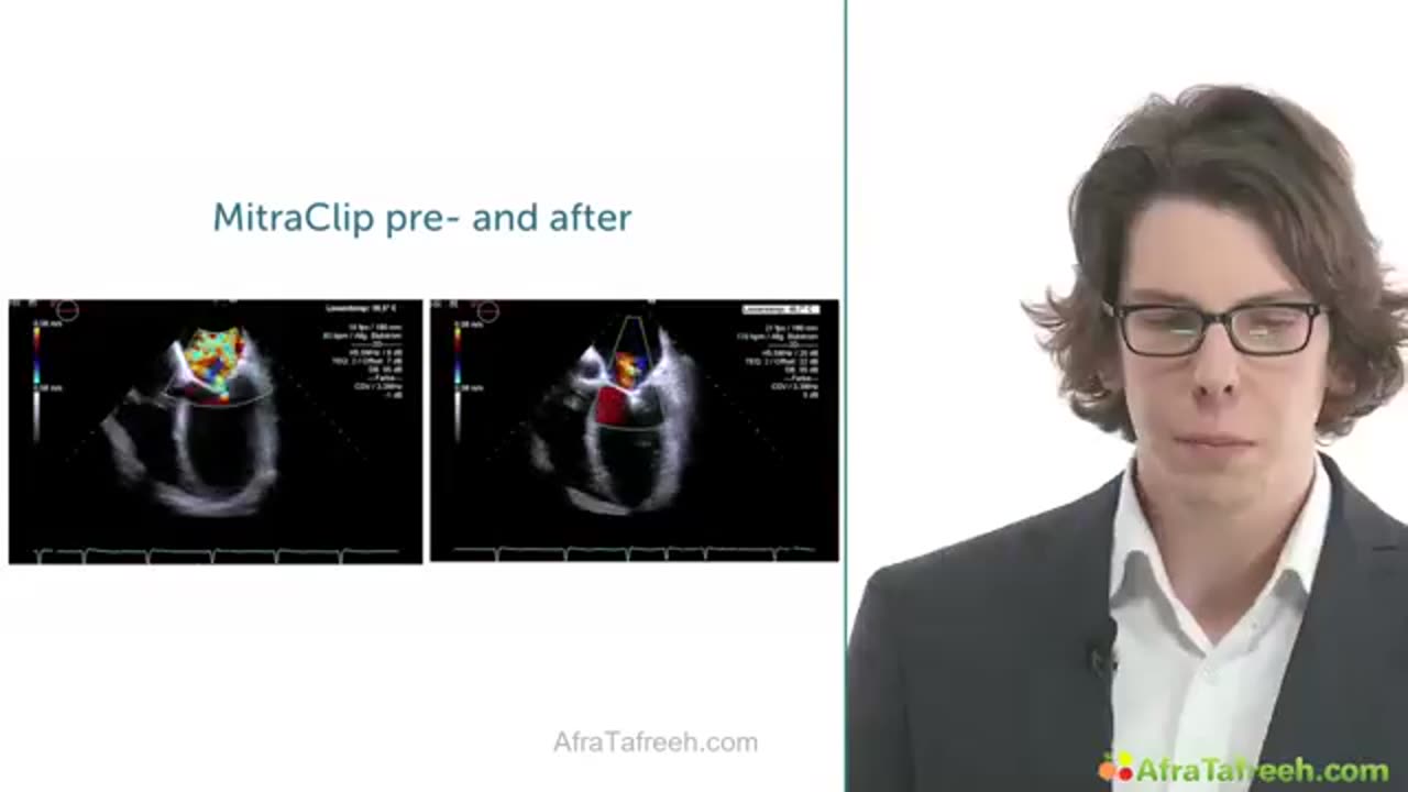 11. Monitoring of Interventions 3. Monitoring of Intervention - MitraClip
