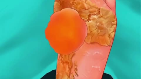 ASMR treatment of acid Burned Feet 2
